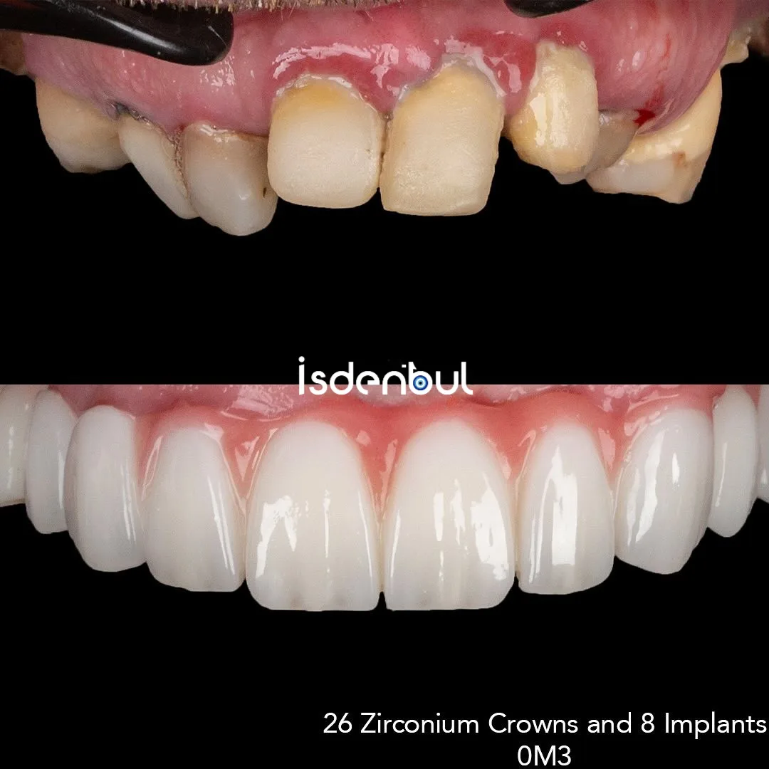Before & After — Dental Implants