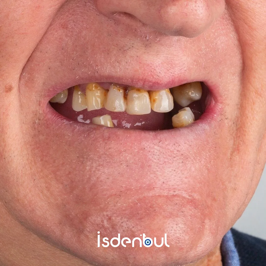 Before Treatment — Dental Restoration
