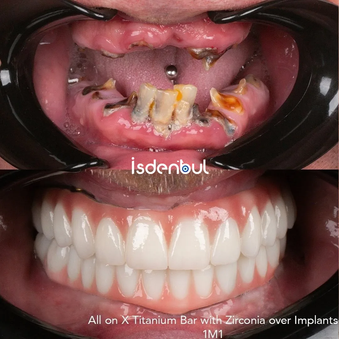 Smile Design Result