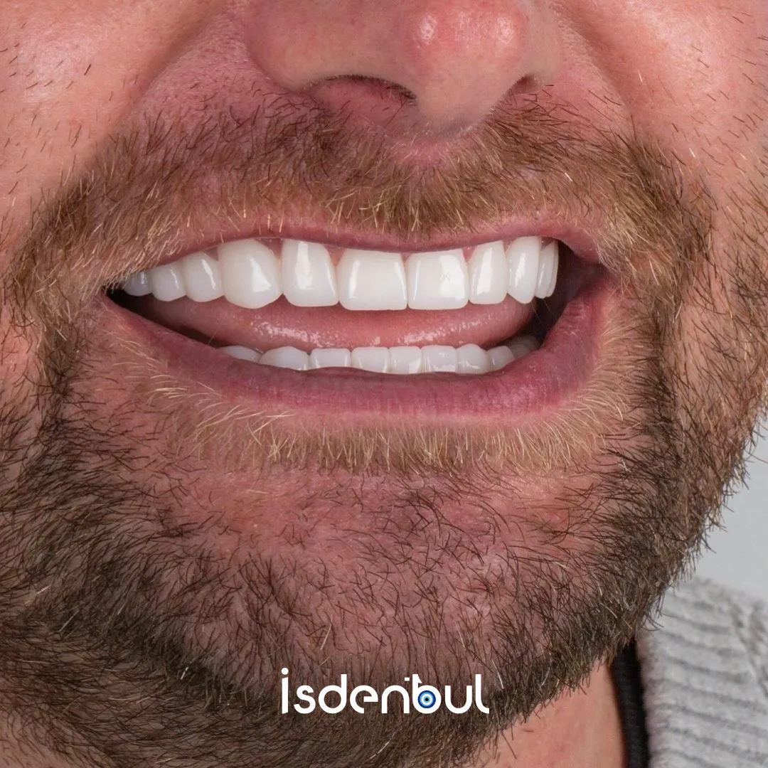 Before & After — Porcelain Veneers